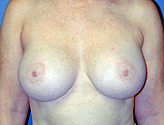Patient # 66527 After Photo # 2